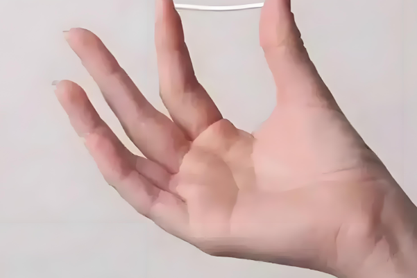 皮埋避孕效果很好