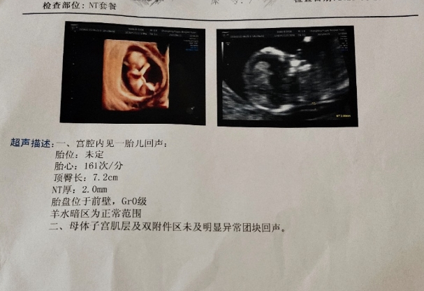 孕早期nt值0.16cm正常吗？