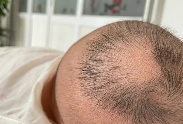 婴儿第三个猛涨期会长头发