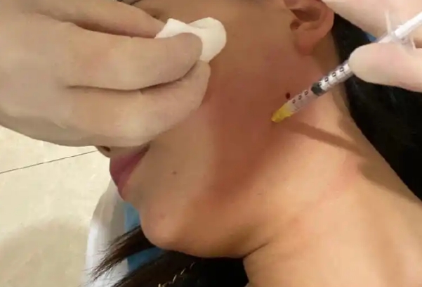 备孕期间准妈妈们可以去医院打瘦脸针吗？