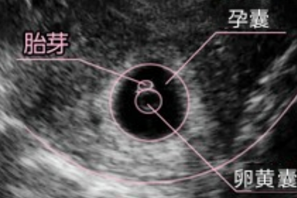 试管移植囊胚一个月后B超检查没看见胎芽正常吗？