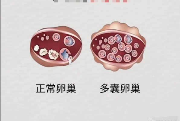 多囊促排能提高人工授精成功率