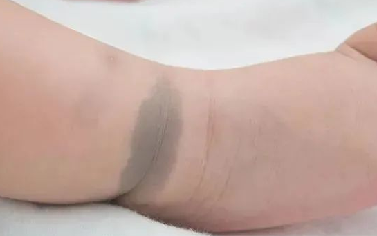 很多宝宝出生时身上都会带有胎记