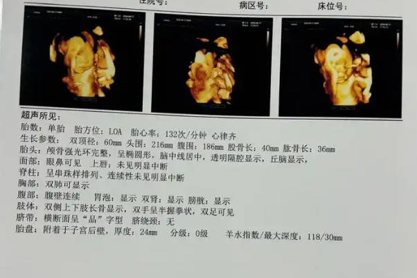 宝妈分享四维彩超看男女诀窍，这些数据可预测胎儿性别