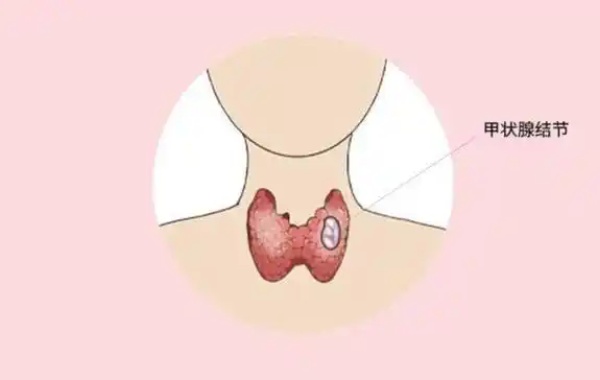 33岁女性甲状腺结节三级做二代试管有影响吗？
