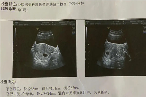 6至7周孕囊形状不规则有卵黄囊没胎芽正常吗?
