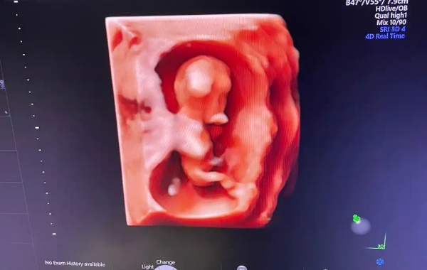 孕早期做nt检查数值重要还是鼻骨重要呢？