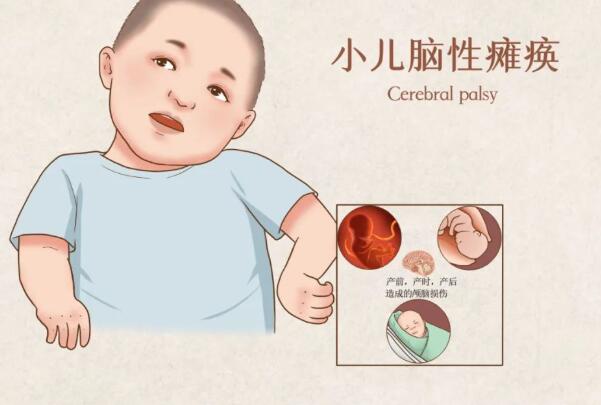 7种方式判断是不是脑瘫，早期出现吞咽困难