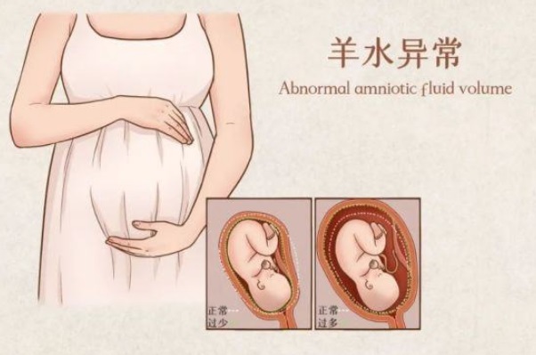 怀孕34周发现羊水少一天要喝多少水才能补到正常水平啊？