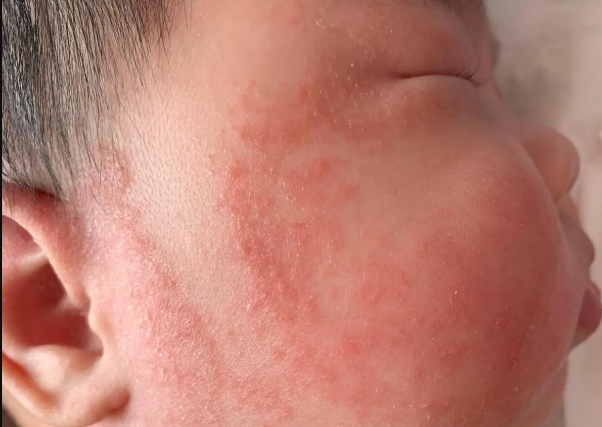有新生儿刚开始长湿疹的图片吗？