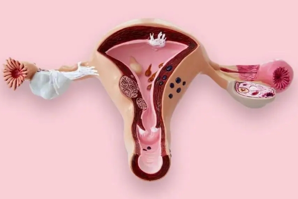 子宫腺肌症会影响试管成功率
