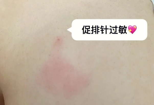 促排针轻微过敏可以做试管