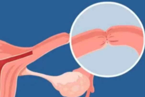 结扎后一般可以做试管婴儿