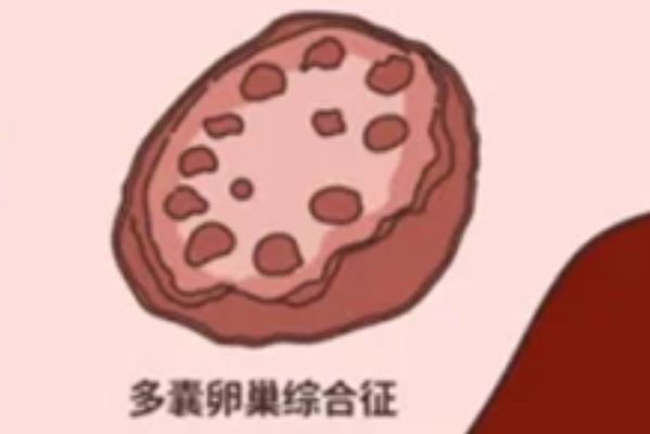 多囊选择促排还是试管因人而异