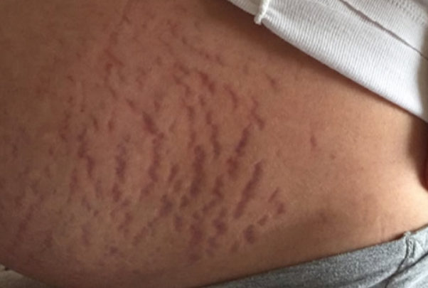 直线型妊娠线的颜色更深