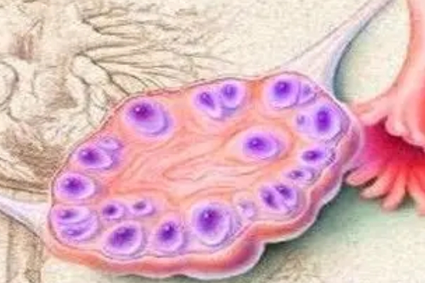 多囊患者不一定促排才能怀孕