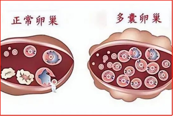 卵子质量会影响多囊试管的成功率