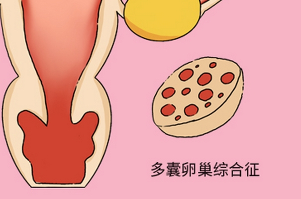 多囊促排失败可以调整方案