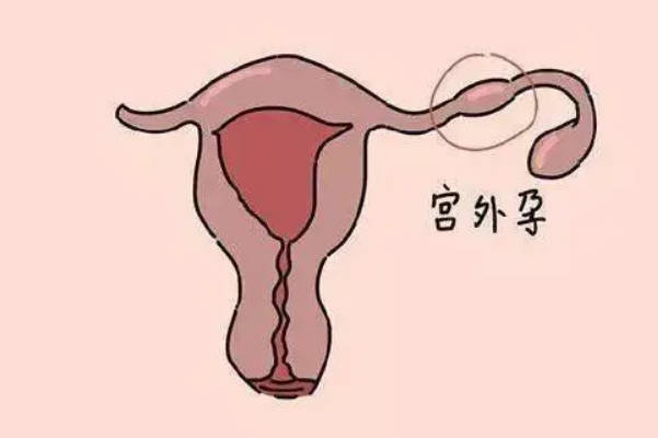 试管婴儿为何易遇宫外孕，听听专家怎么说，原因一次讲清！