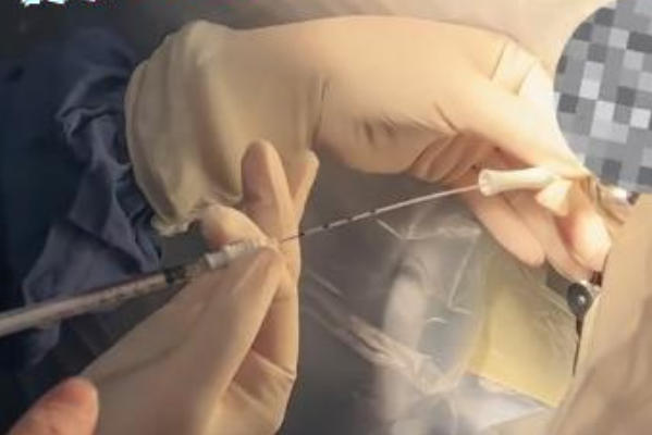 移植胚胎好还是移植囊胚好？试管婴儿移植方案全解析