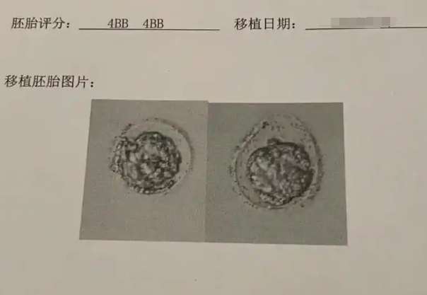 网传试管移植囊胚选择4bb级别生来的都是女孩真的吗？
