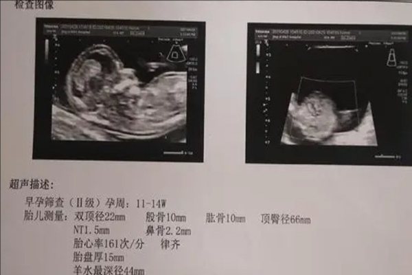 nt1.5mm是正常范围