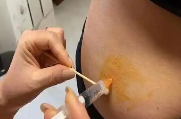 达菲林注射部位肿痛怎么处理，不同情况方法有差异