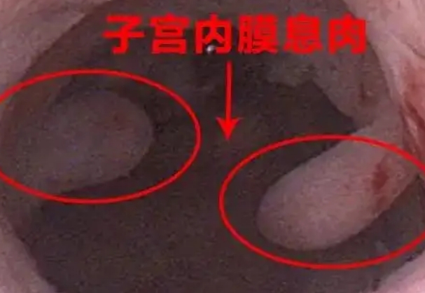 内膜息肉10×6mm不严重