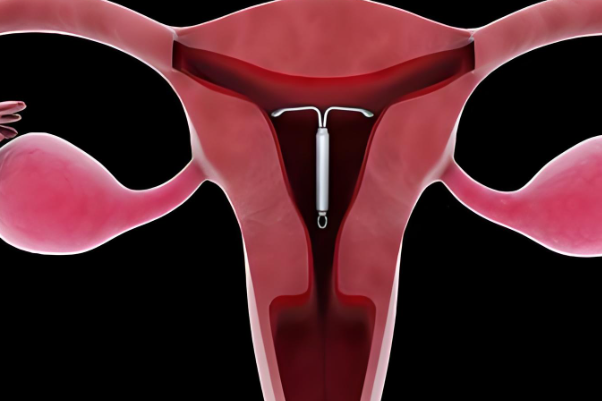 女性宫腔形态不规则还能做试管生孩子吗？