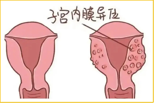 腹壁子宫内膜异位症八年，规范诊疗是关键‌