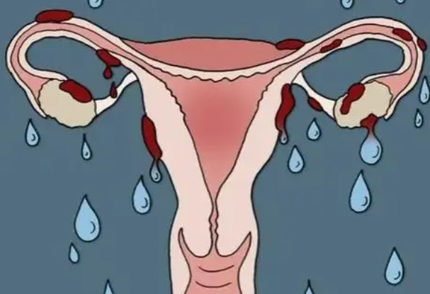 子宫内膜异位症会影响怀孕