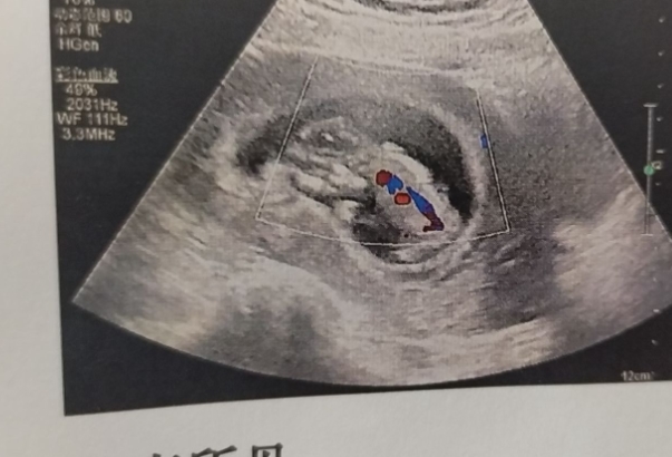 试管nt检查发现胎儿比实际孕周小一周要紧吗？