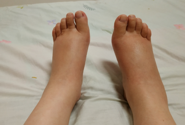 孕妇脚三肿三消是男孩的说法准不准？