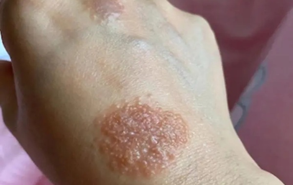 亚急性期主要表现为渗出和红肿减轻
