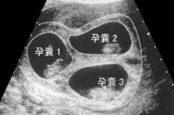 多胎妊娠会影响hcg水平