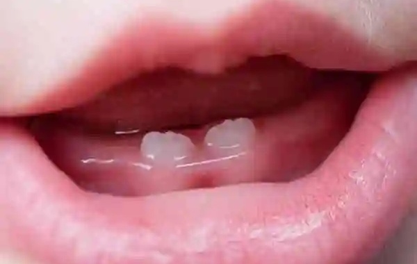 单出牙的宝宝以后会非常的不合群
