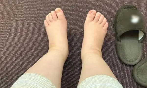 怀孕四个月的时候手脚会变肿