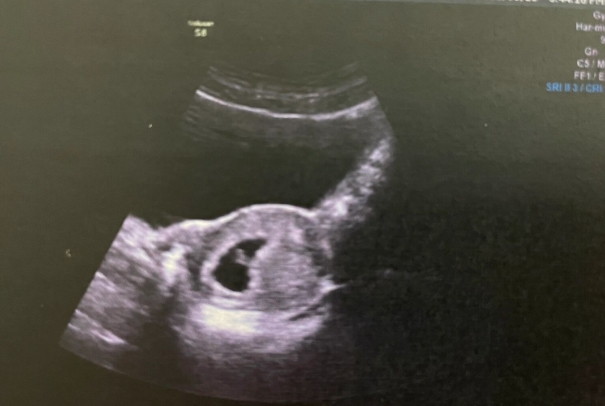 女方多囊和老公精子活力差做几代试管成功率高？