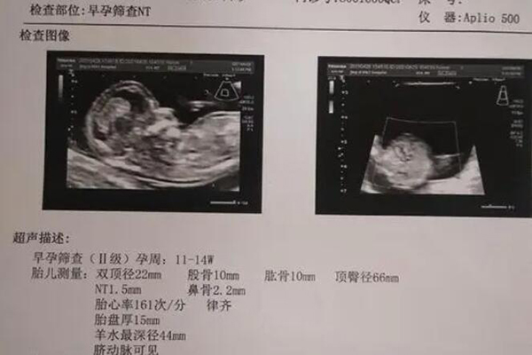 nt检查已过还要做羊水穿刺