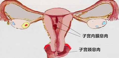 导致子宫内膜息肉产生的原因有很多