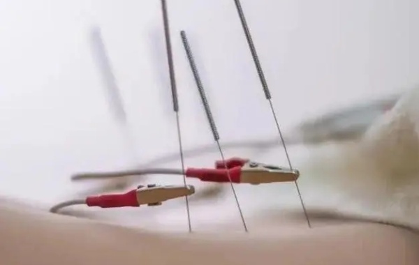 针灸避孕的方法在2天内做有效