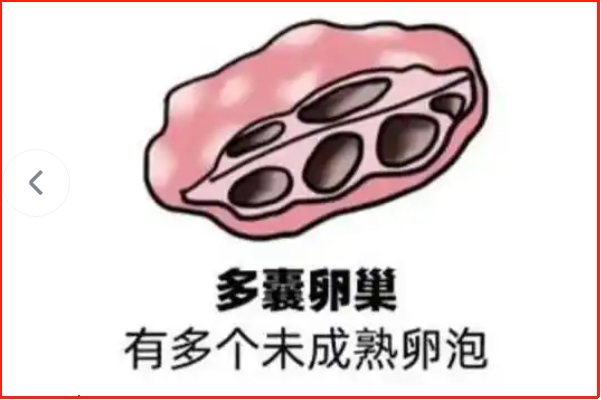 多囊做试管不能随便进行促排卵治疗