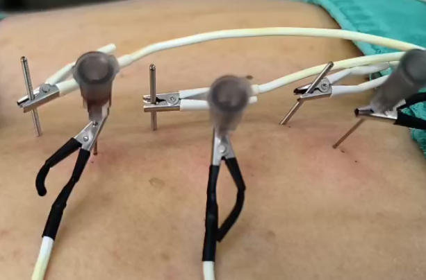 经皮电刺激治疗会提高试管移植的成功率