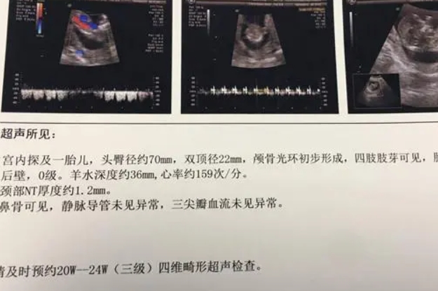 胎儿nt值1.6mm是男孩可能性大还是女孩？