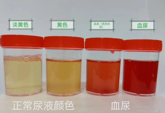 健康尿液颜色为透明无色