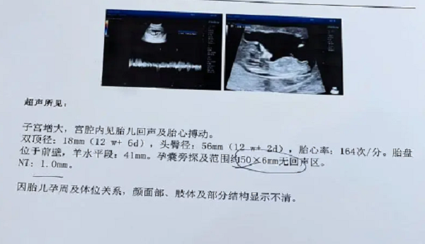 nt值大于1.5mm怀男娃的几率很大