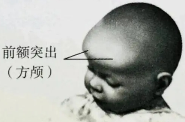 佝偻病是缺乏维d引起