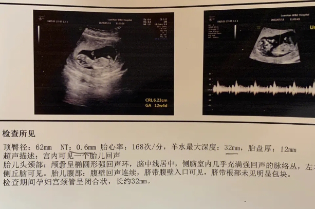 胎儿nt值男女参照表的准确率怎么样？
