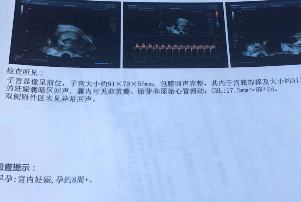 已生男孩孕囊数据参考，b超孕囊呈茄子型大多数男宝
