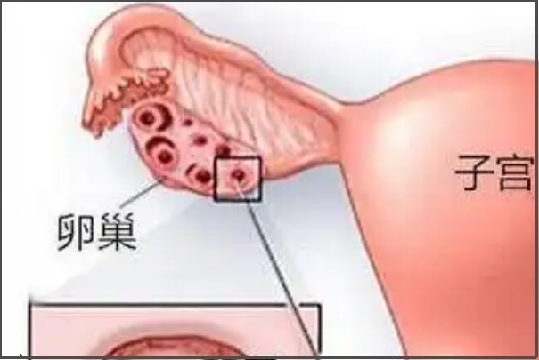 连续促排容易导致OHSS
